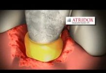 VIDEO: ATRIDOX® Applied for Treatment of Chronic Adult Periodontitis