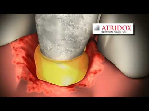 VIDEO: ATRIDOX® Applied for Treatment of Chronic Adult Periodontitis