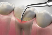 INFOGRAPHIC: The Smart Choice in Inserts