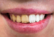 Ask Kara RDH: What can I recommend to patients with heavy stain?