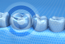 Is Silver Diamine Fluoride the Key to Preventing Caries in Under-served Populations?