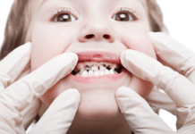 Fluoride Varnish Shown to Prevent Dental Caries in Young Children