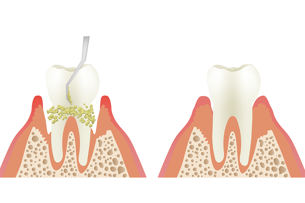 The Education Process of Prophylaxis vs. Scaling and Root Planing