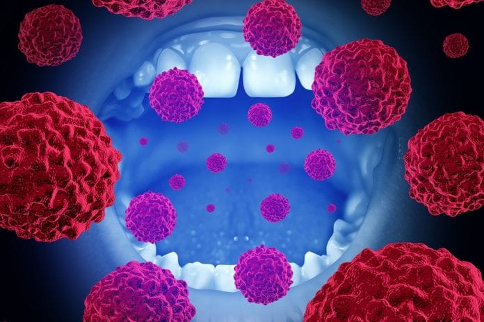 More Evidence Points to Colon Cancer and Lung Cancer Links to Periodontitis