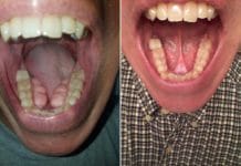 A Patient’s Story of Tori Removal