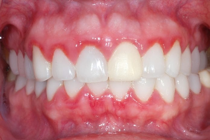 Clinical Trial Shines Spotlight on Dental Hygiene and Desquamative Gingivitis