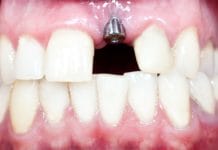 Implant Maintenance: An Overview