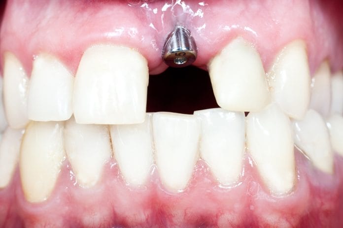 Implant Maintenance: An Overview