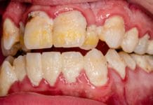 The Oral Bacteria Prevotella intermedia and its Link to Gout and Hyperuricemia