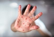 Measles: How Dentistry Can Help Slow Outbreak Through Diagnosis