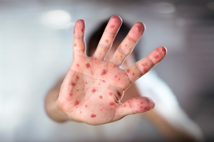 Measles How Dentistry Can Help