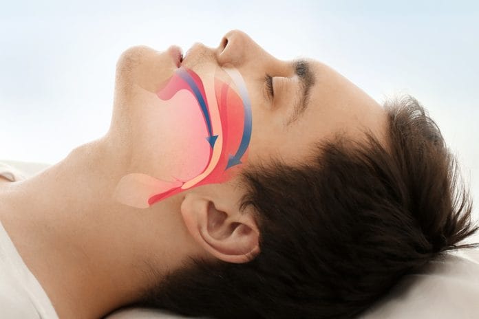 Upper Airway Resistance Syndrome