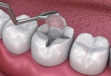 Restorative: Additive Developed in Oregon Could Strengthen Treatment Options