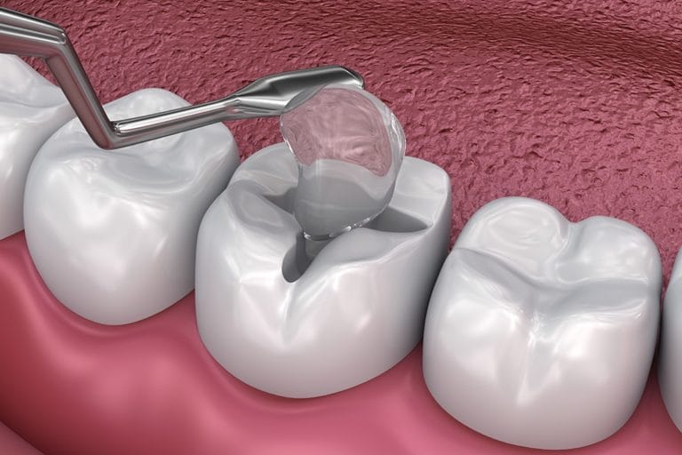 Restorative Additive Developed in Oregon Could Strengthen Treatment