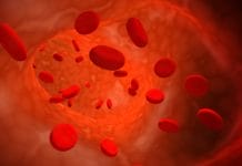 Iron-Deficiency Anemia: What Dental Hygienists Need to Know