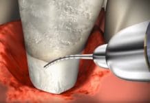 QUIZ: Test Your Locally Applied Antibiotics Knowledge!