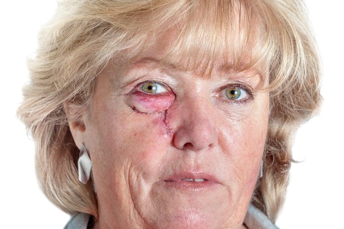 2 Basal Cell Carcinoma