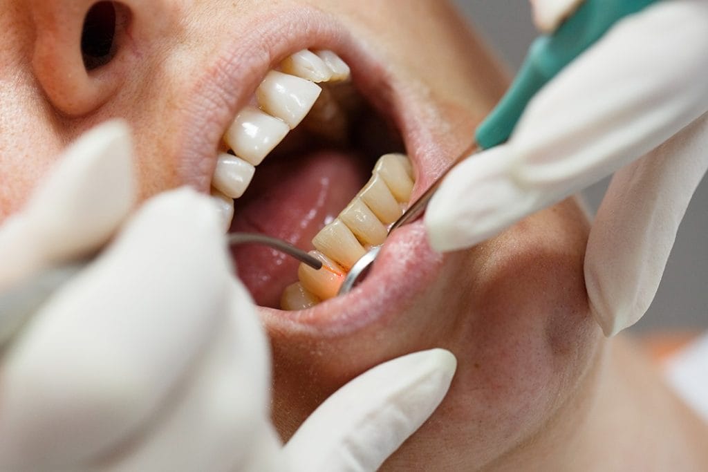 4 Tips to Using Dental Lasers in the Hygiene Operatory Today's RDH