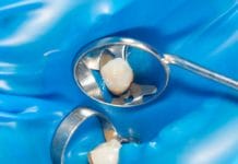 Dental Sealants: Making a Choice in Etching