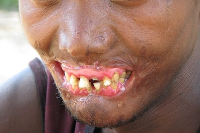 Noma (Cancrum Oris): A Case of a Third World Disease in a First World Country