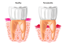 QUIZ: Test Your Periodontitis Knowledge