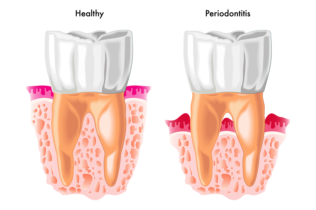 QUIZ Test Your Periodontitis Knowledge Today's RDH