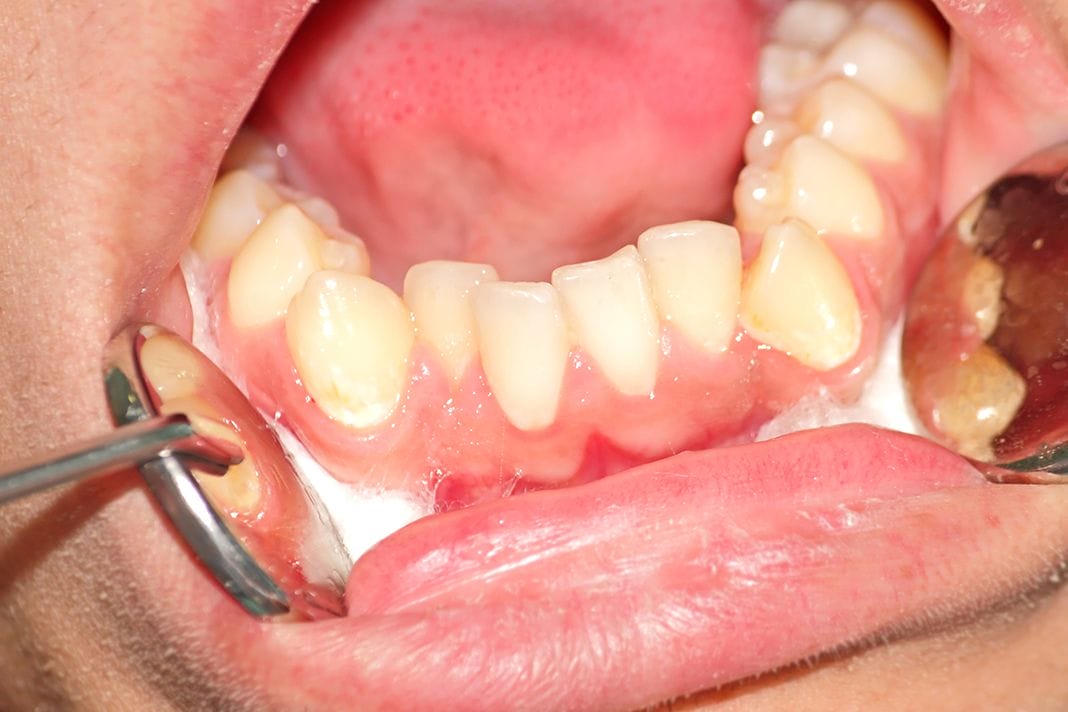 Mandibular Anterior Crowding: What is the Etiology? - Today's RDH