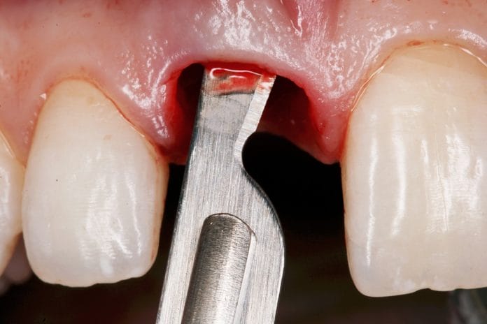 Study Finds Replacement for Oral Surgery Blades