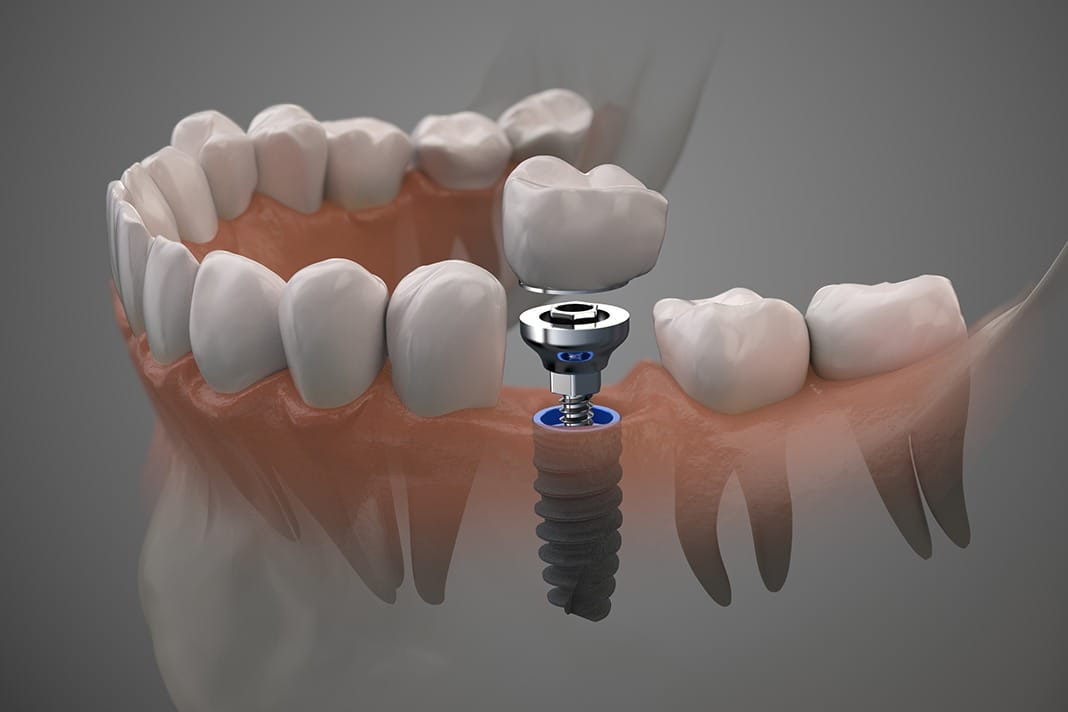 All On 4 Dental Implants Albany Ny