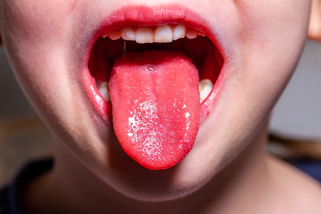 Strawberry Tongue: Systemic Health Influences This Oral Health Condition -  Today's RDH
