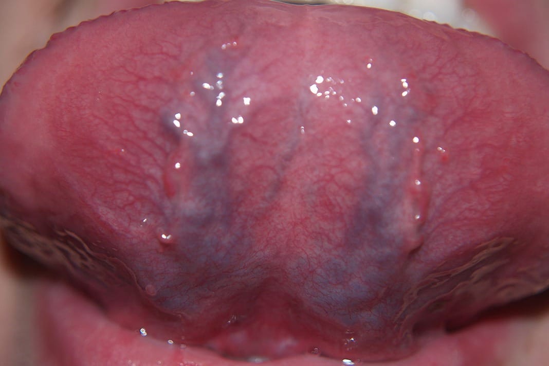 vitalitet modstå solsikke Caviar Tongue: Are Dental Hygiene Patients Displaying Signs of “Aging?” -  Today's RDH
