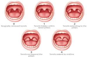 Tonsils: Close Scrutiny Can Pinpoint Disease and Raise Oral Health ...