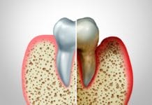 Visual Aids Showing Severe Periodontitis Shown to Motivate Periodontally-involved Patients