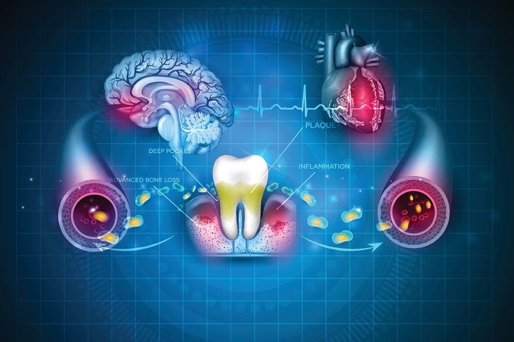 Research Explains Link Between Periodontal Disease And Overall Health Today S Rdh