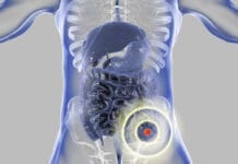 Severe Periodontal Disease Linked to 21% Increased Risk of Colorectal Cancer