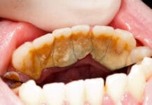 Adjunctive Use of Experimental Calculus Disruption Solution Decreases Scaling Time