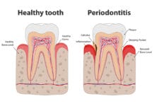 Why Are You Still Delaying Periodontal Treatments?