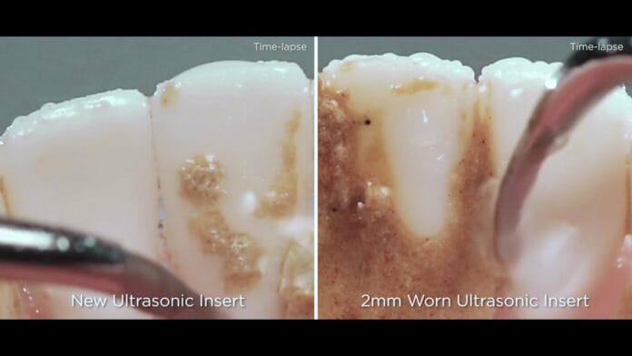 VIDEO: The Impacts of Ultrasonic Insert Tip Wear
