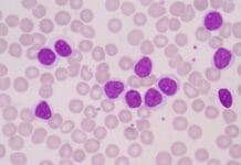 Oral Myeloid Sarcoma Lesions Linked to Acute Myeloid Leukemia