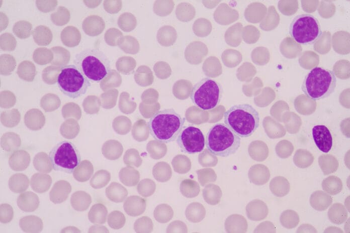 Oral Myeloid Sarcoma Lesions Linked to Acute Myeloid Leukemia