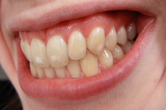 dental fluorosis