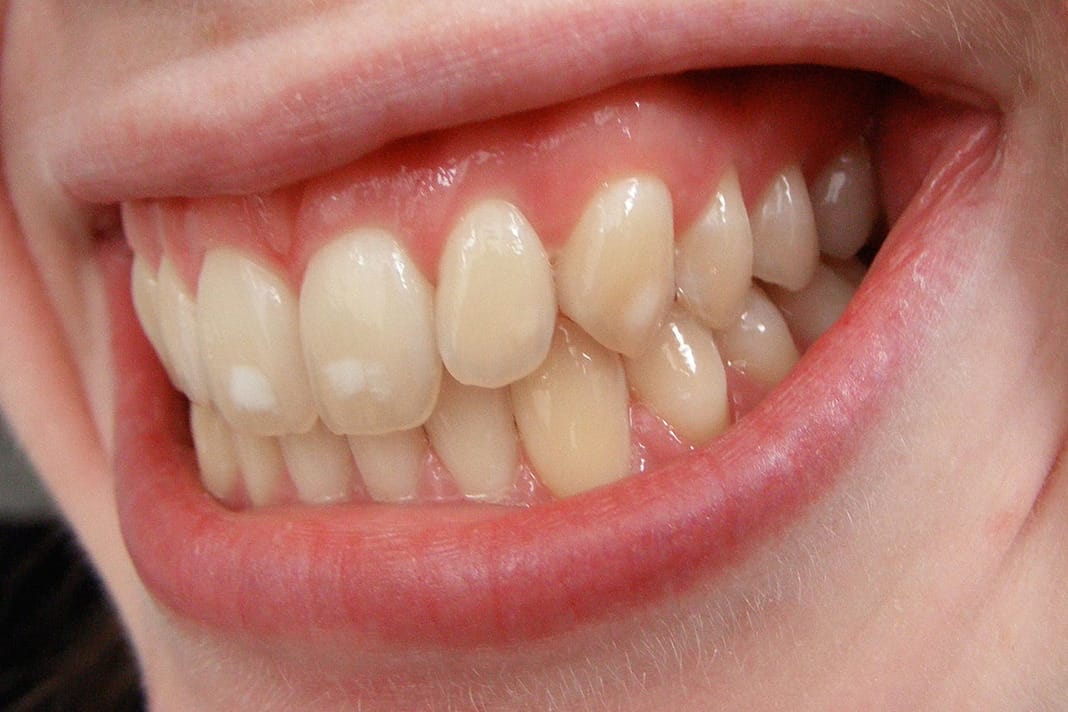 Study Evaluates Changes In Dental Fluorosis Over Time - Today's RDH