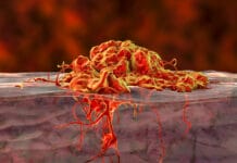 Oral Malignant Melanoma: A Rare Neoplasm Dental Hygienists Should Monitor