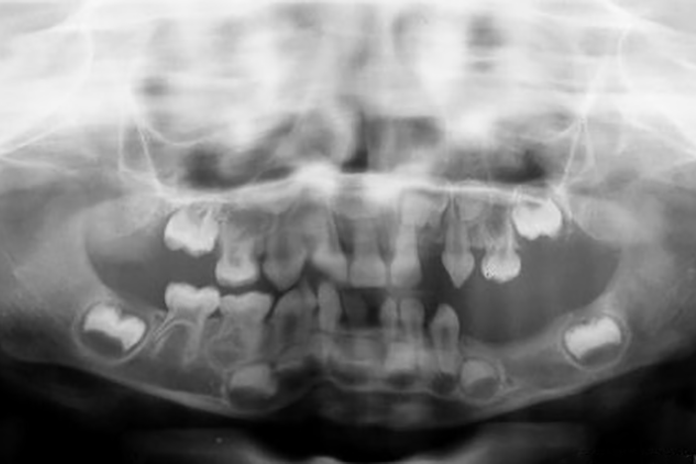 Tooth Agenesis: Oral Health Diagnosis Should Prompt Screening for Systemic Disease