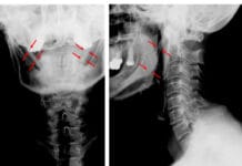 Eagle Syndrome: Dental Professionals can Identify Painful Condition on Panoramic Radiograph