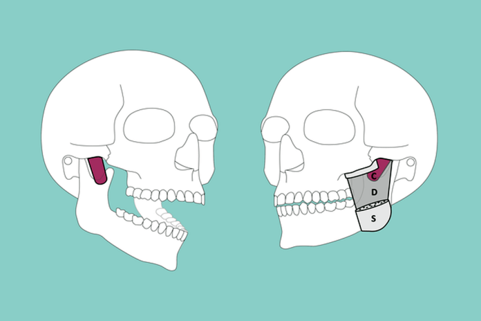 Musculus Masseter Pars Coronidea