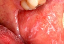 Topical Steroid Treatment for Oral Lichen Planus: Does It Cause Candidiasis?