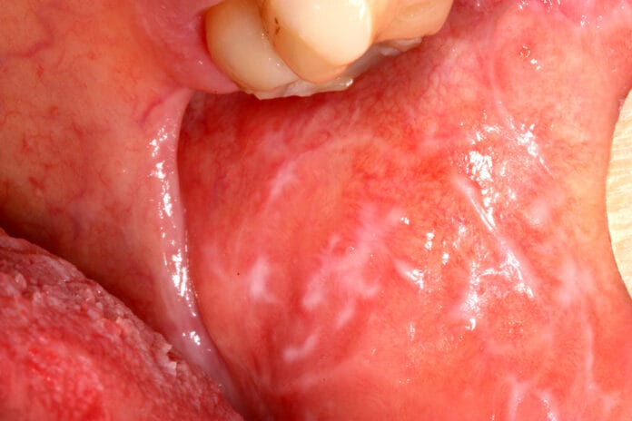 Topical Steroid Treatment for Oral Lichen Planus: Does It Cause Candidiasis?
