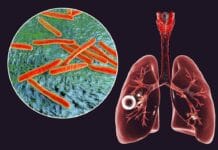 A Dental Hygienist’s Refresher on Tuberculosis