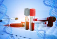 Congenital Hemophilia and Increased Caries Risk: Dental Treatment and Homecare Tips